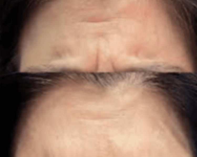 Botox entrecejo (Frown lines botox)