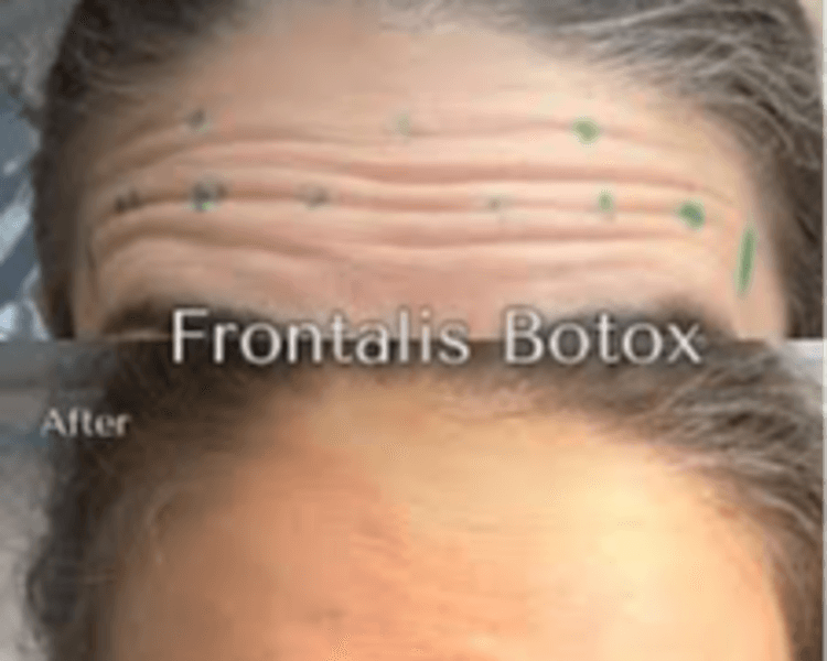 Botox Frente (Forehead botox)