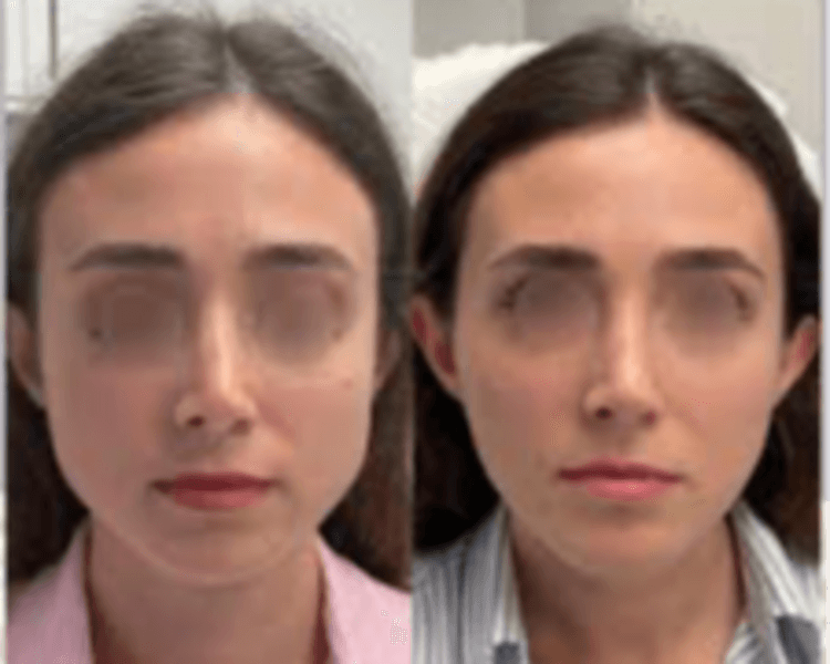 Botox Masetero / Masseter Botox / Bruxismo / TMJ Botox