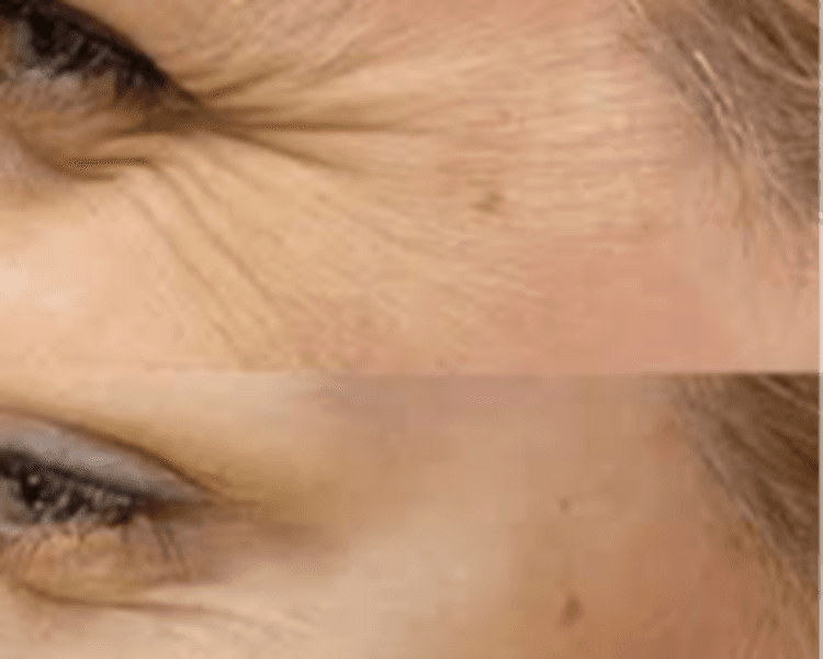 Botox patas de gallo (Crows feet botox)