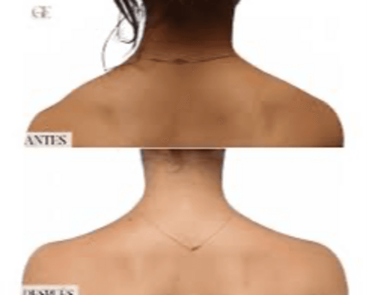 Botox Trapecio / Trap-tox / Barbie Botox