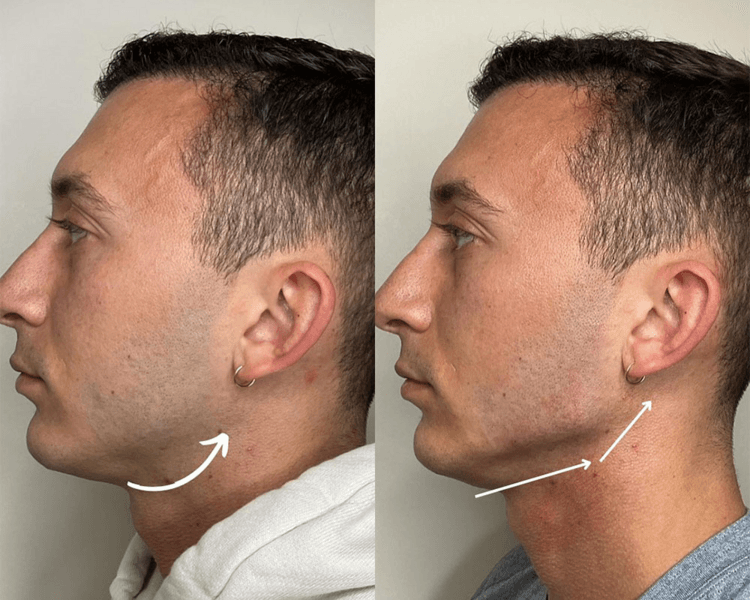Marcaje Mandibular / Jawline Filler
