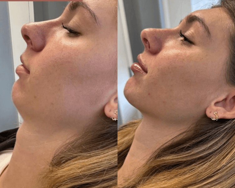 Relleno de Mentón / Chin Filler