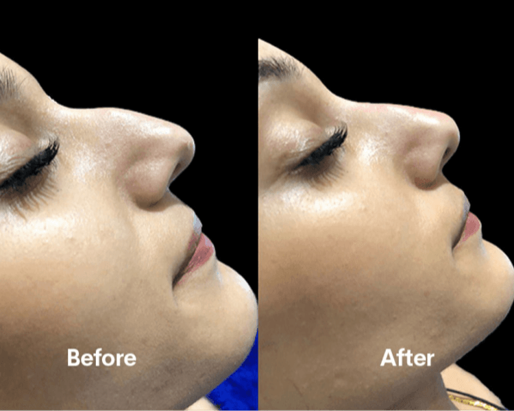 Rinomodelación / Nose-job Filler