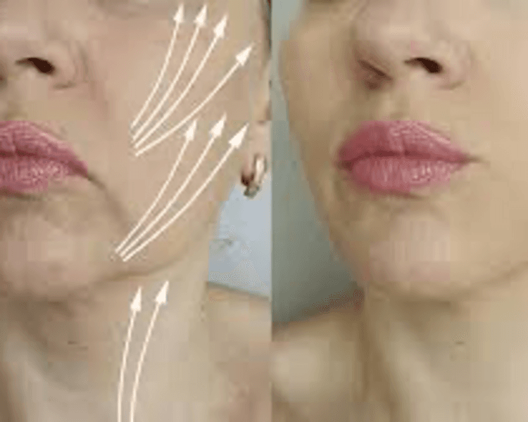 Hilos tensores PDO (precio 5-8 hilos, precio x hilo) / Barbed PDO threads (Price for 5-8 threads, price per thread)