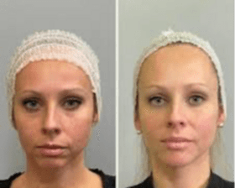 Full Face Botox (60 u) Allergan, Dysport, or Xeomeen