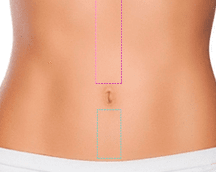 Depilación de abdomen