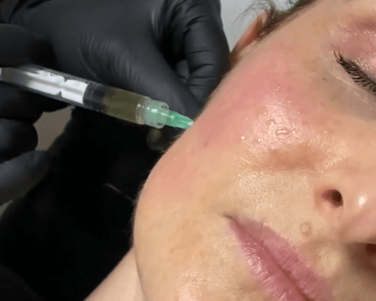 🩸PRP Facial-BA (Rostro, cuello y escote)🩸✨