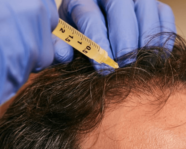 🩸PRP Capilar-BA (Regeneración y estimulación folicular) 🩸🌿