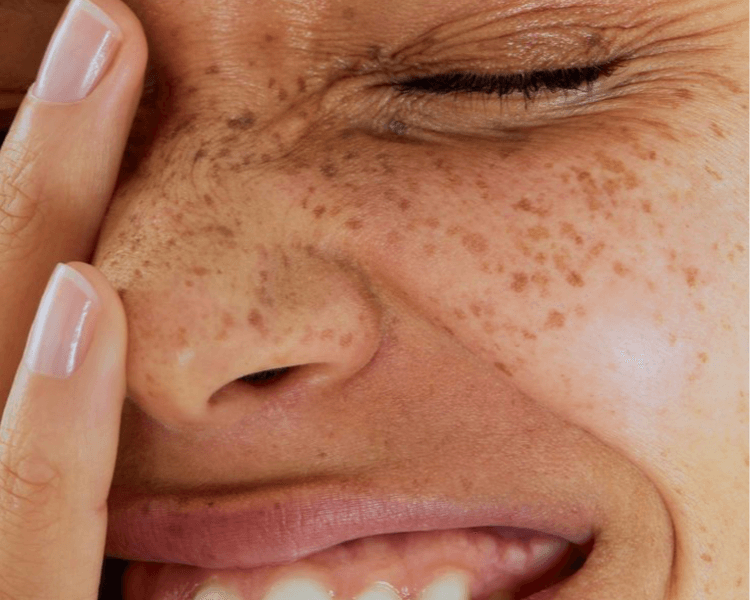 👁️ Tratamiento de Ojeras-BA (mirada descansada) 🌿