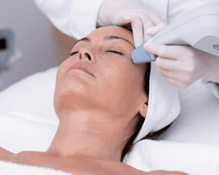 Tratamiento EXILIS 360