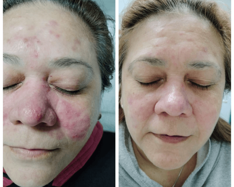 tratamiento de rosácea ( previa evaluación )