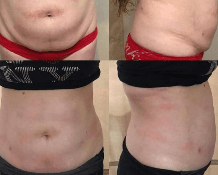 sesión de reductivo 1 zona