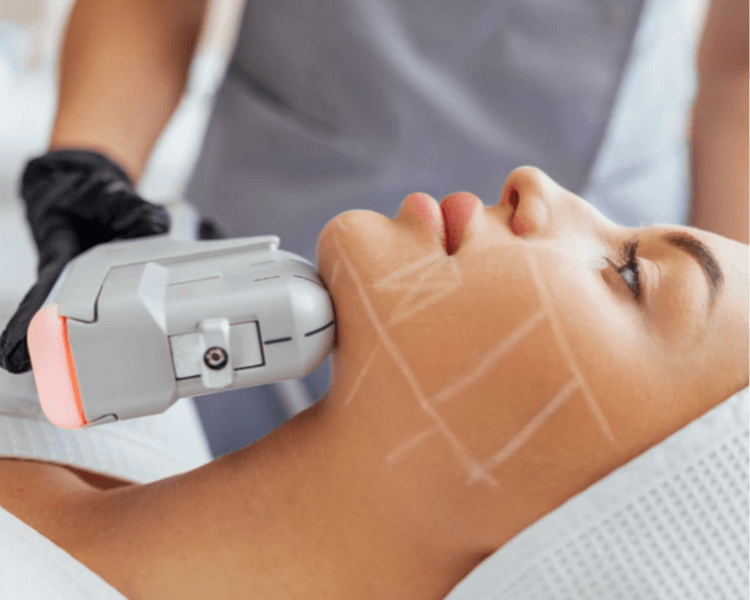 HIFU CUELLO (3 sesiones)