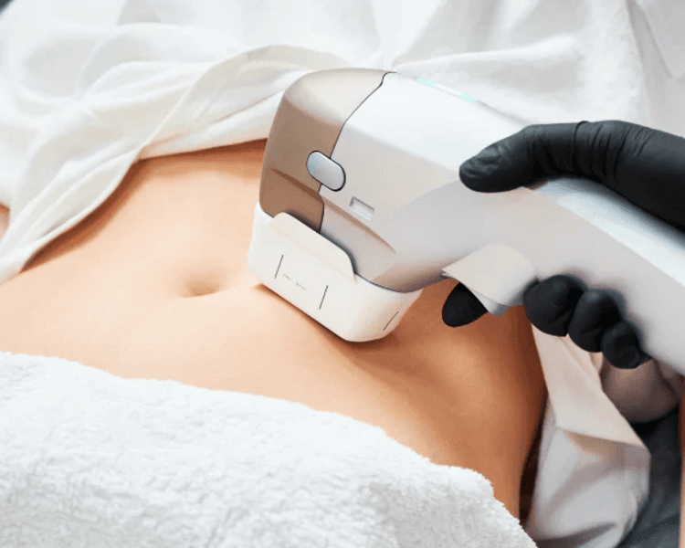 HIFU CORPORAL 2 zonas (3 sesiones)