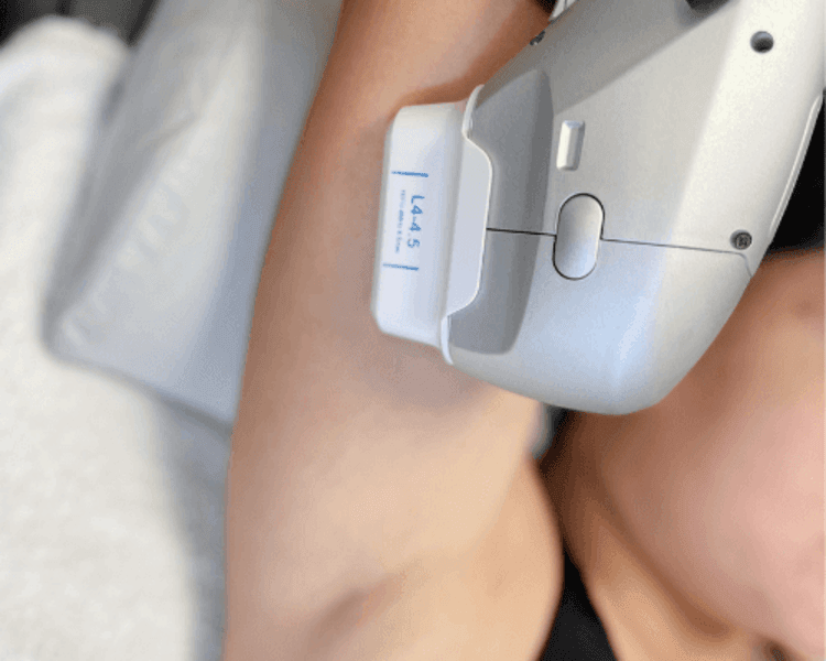 HIFU CORPORAL 3 zonas (3 sesiones)