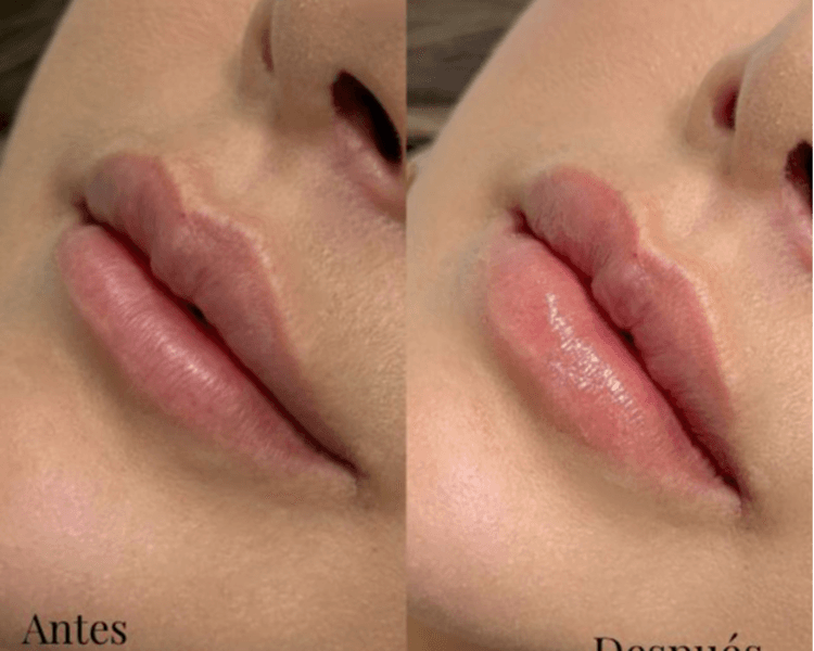 Ácido hialurónico labios