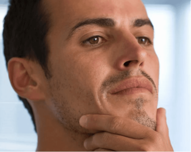 Ácido hialurónico marcación mandibular