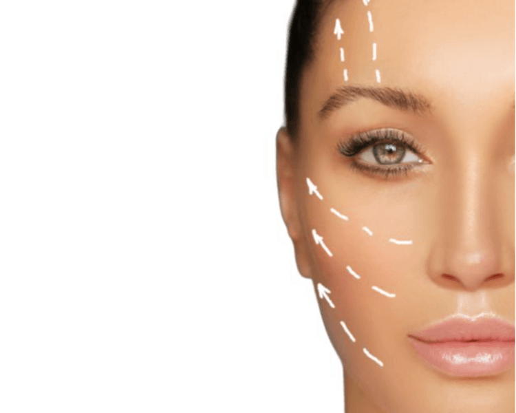 Lifting facial con ácido hialurónico