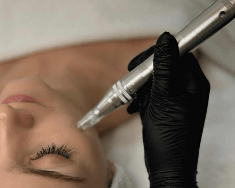 Microneedling (Microagujas, Dermapen)