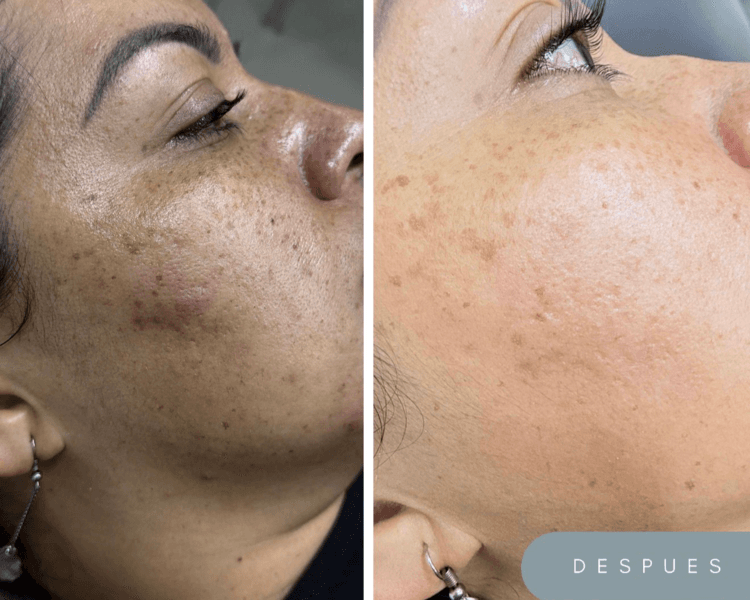 Kiara (Esperma de Salmón)