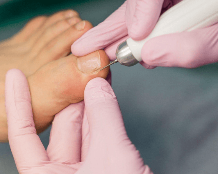 QUIROPODIA ( CORRECION DE LATERALES)