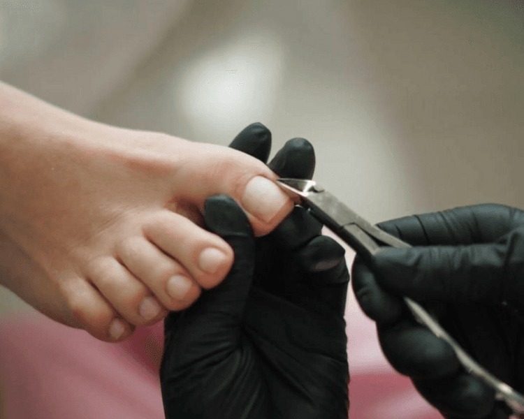 QUIROPODIA ( UÑAS ENCARNADAS)