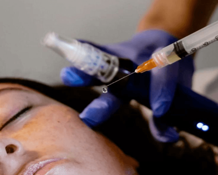 Plasma Rico en Plaquetas (PRP) Facial