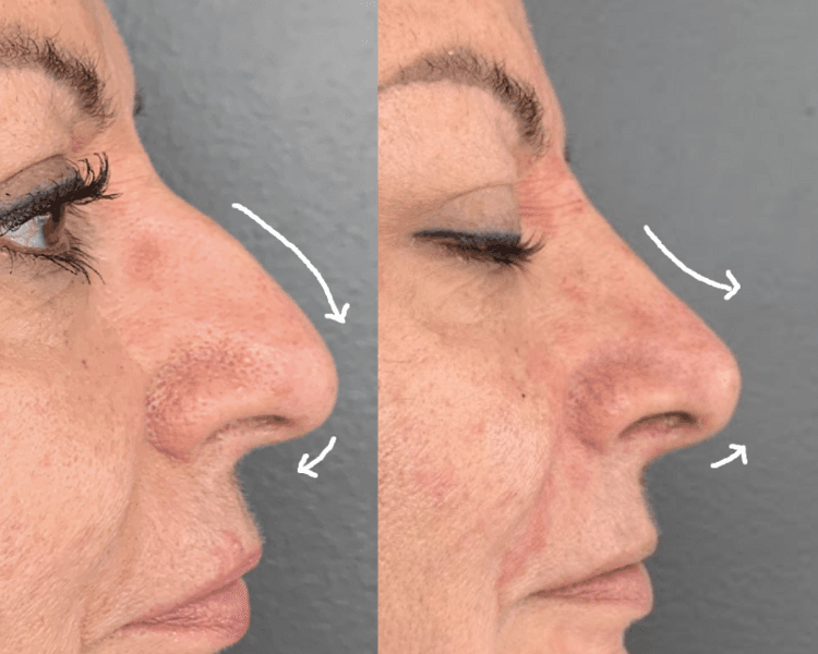 Ácido hialurónico: Rinomodelación (1mL)