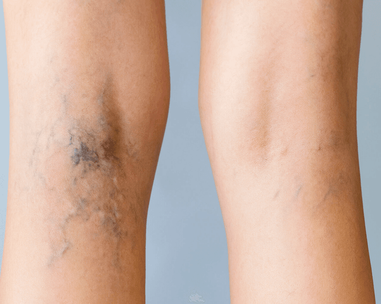 Escleroterapia