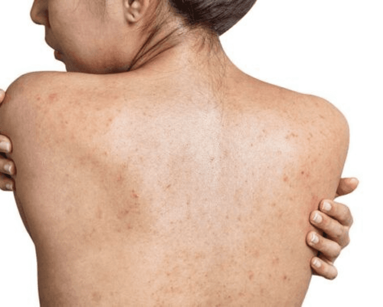 Laser fotona foculitis