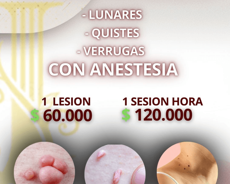 1 SESION DE CAUTERIZACION