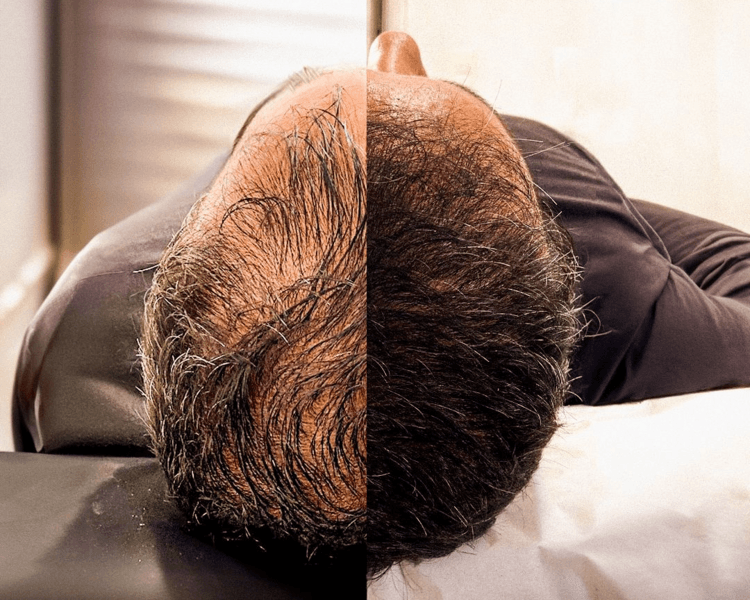 Mesoterapia capilar