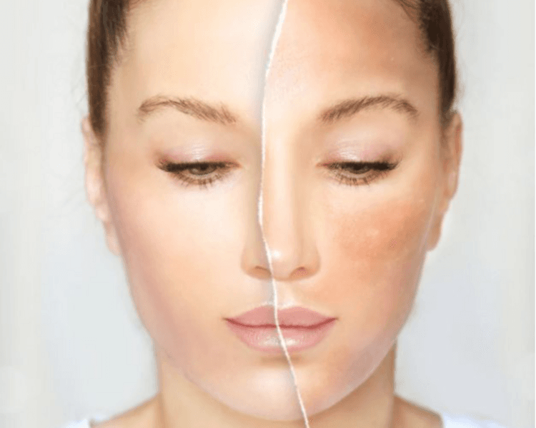 Despigmentación química