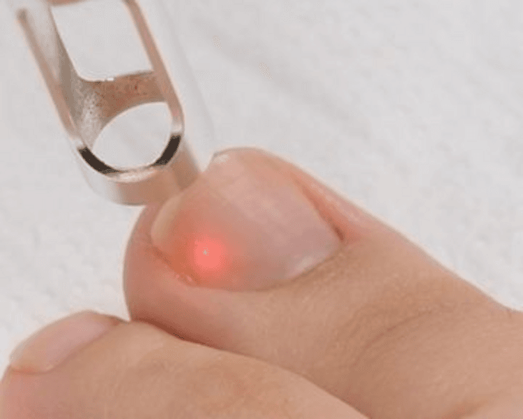 Laser (de 6 a 10 uñas)