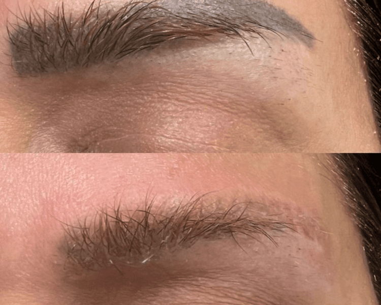 Eliminación de Micropigmentación