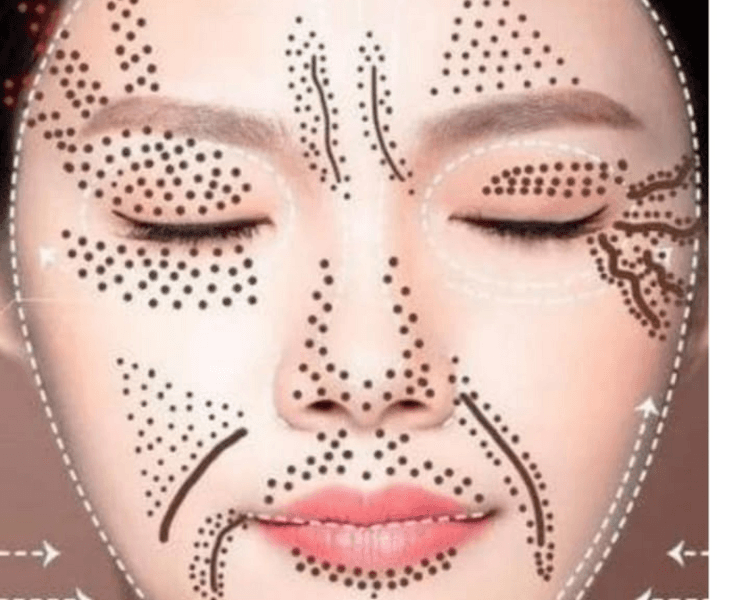 Rejuvenecimiento, levantamiento