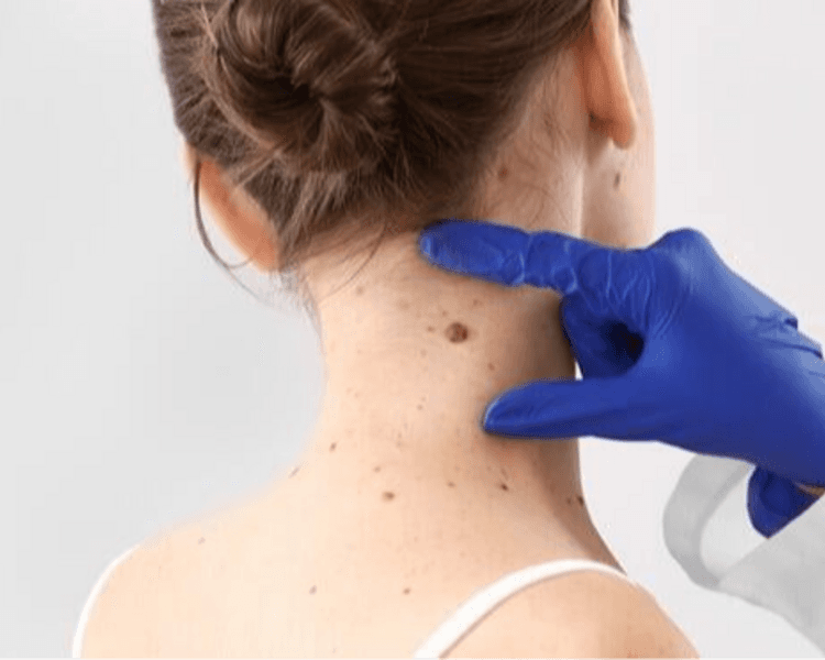 Extracción lunar 👩🏻⚕️