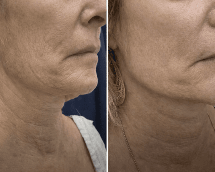 Laser CO2 Fraccionado - Lifting cervical