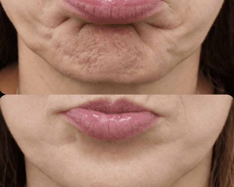 Toxina Botulinica - Tercio medio e inferior