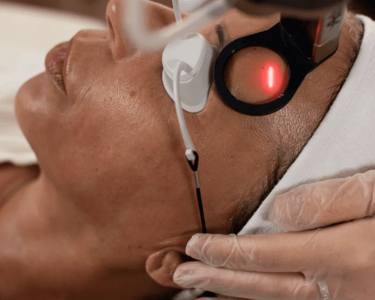 Laser CO2 Ablativo - Lesion facial
