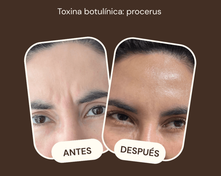 Toxina Botulinica Tercio Superior