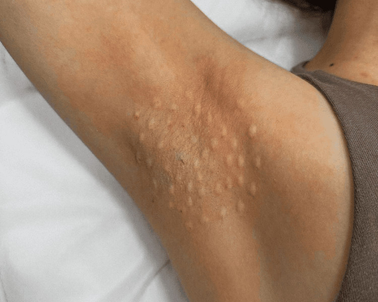 Toxina Botulinica Hiperhidrosis