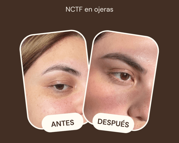 NCTF ojeras