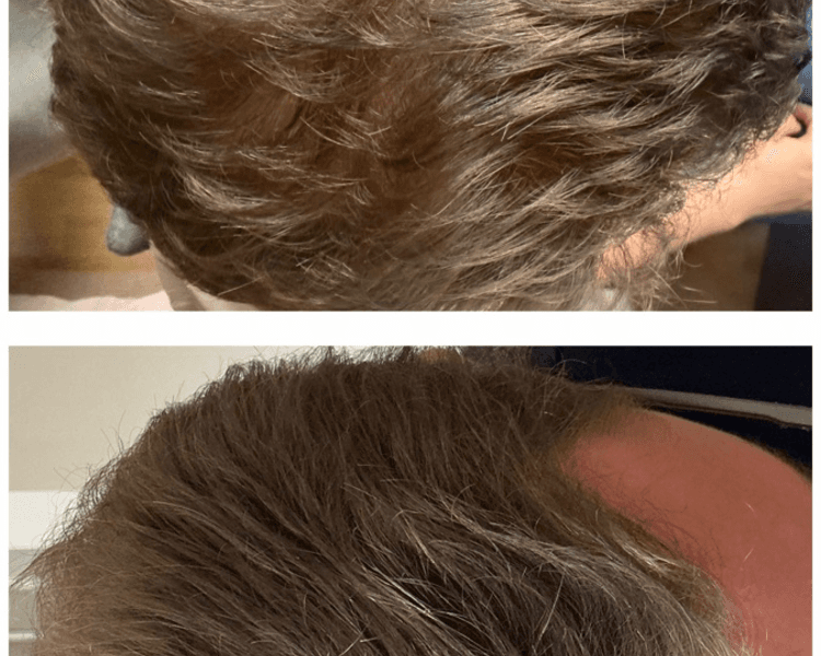 Mesoterapia Medica Capilar