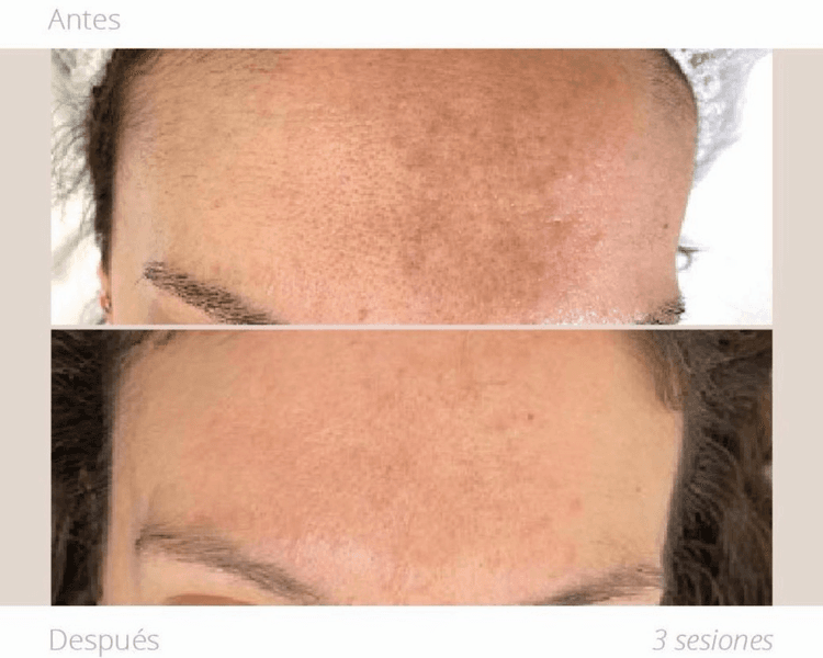 Nanopore Rostro / Cuello / Escote