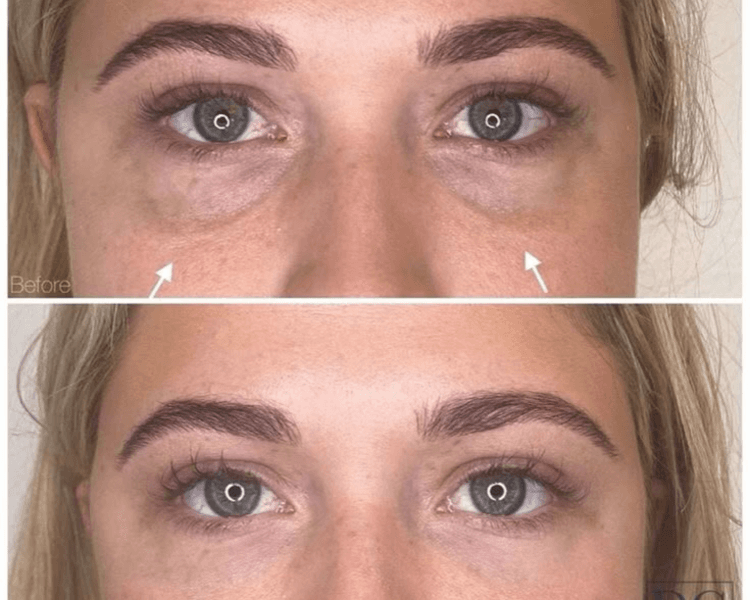 Relleno de Ojeras / Menton