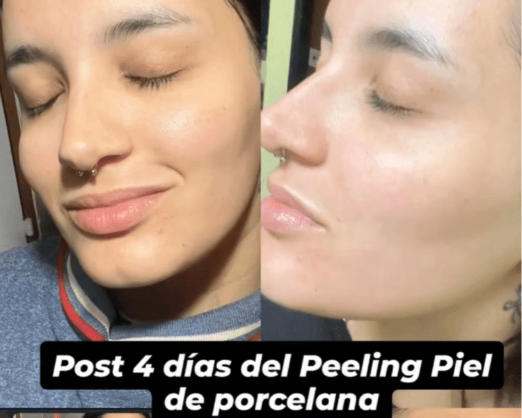 Peeling piel de porcelana