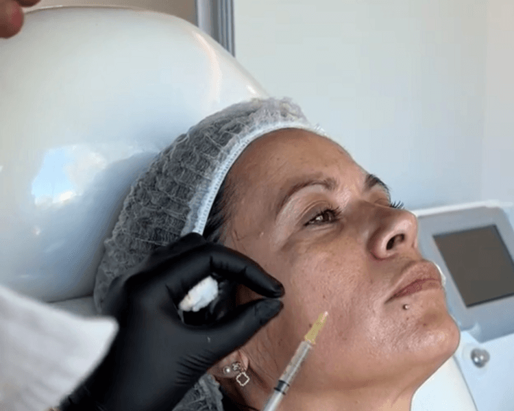 Mesoterapia facial