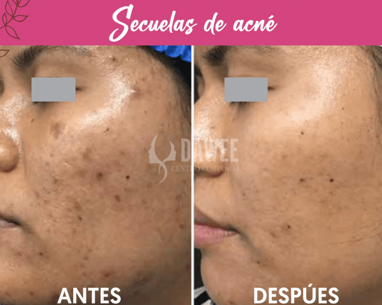 Laser Co2 Fraccionado 💆🏻♀️